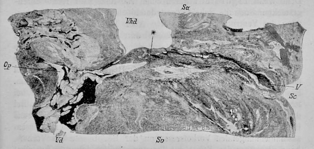 Bundle of His (1893) fig 4