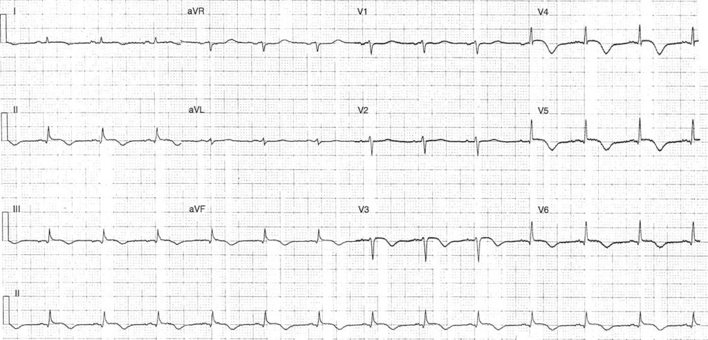 ECG Case 083 LITFL Top 100 EKG