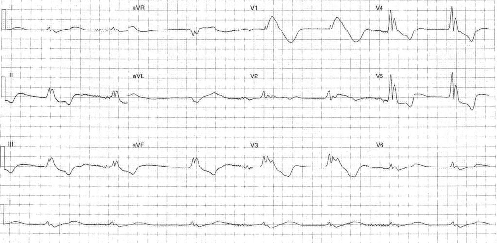 ECG Case 088 LITFL Top 100 EKG