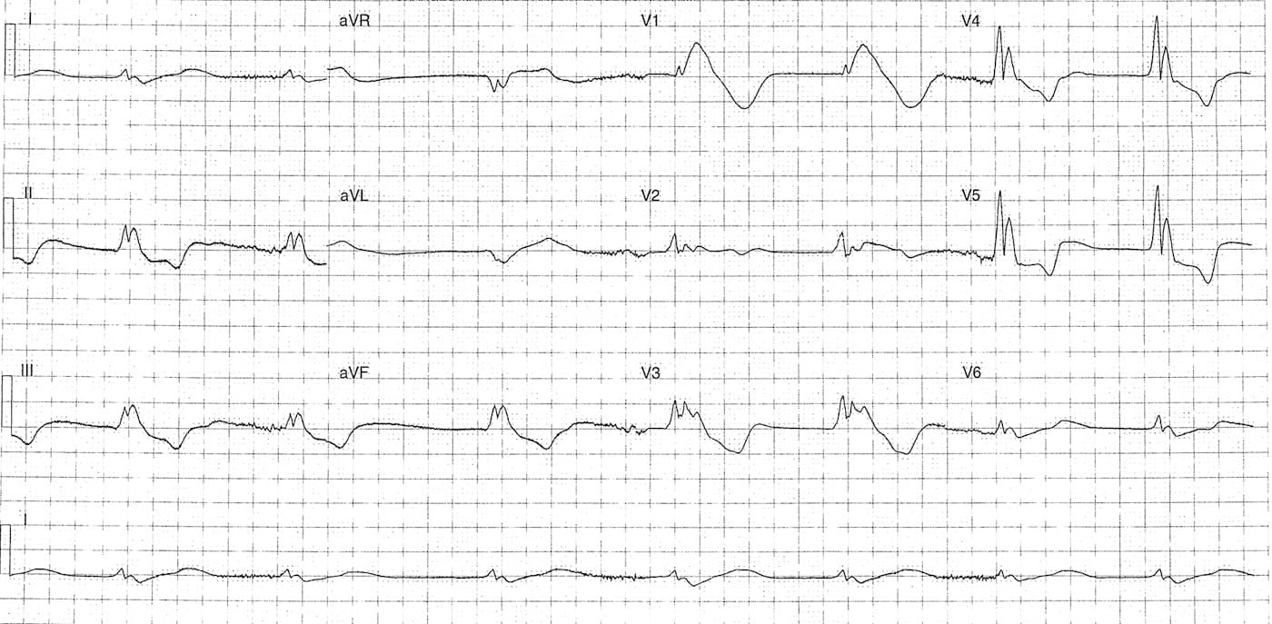 Экг ребенку в год. Sinus arrhythmia ECG. ECG 283. ECG value. ECG John xempton.