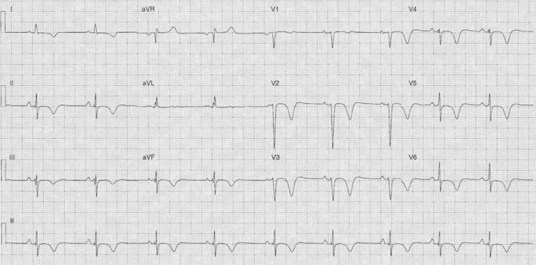 ECG Case 102 • LITFL • ECG Top 100 Self-Assessment Quiz