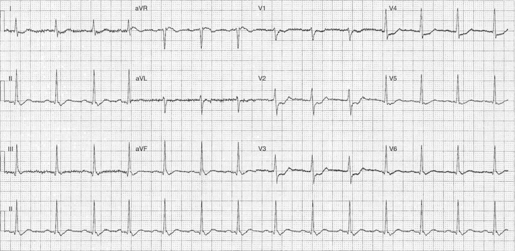 ECG Case 103a LITFL Top 100 EKG