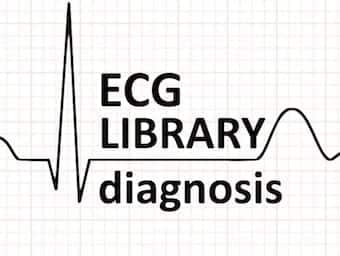 Benign Early Repolarisation • LITFL • ECG Library Diagnosis