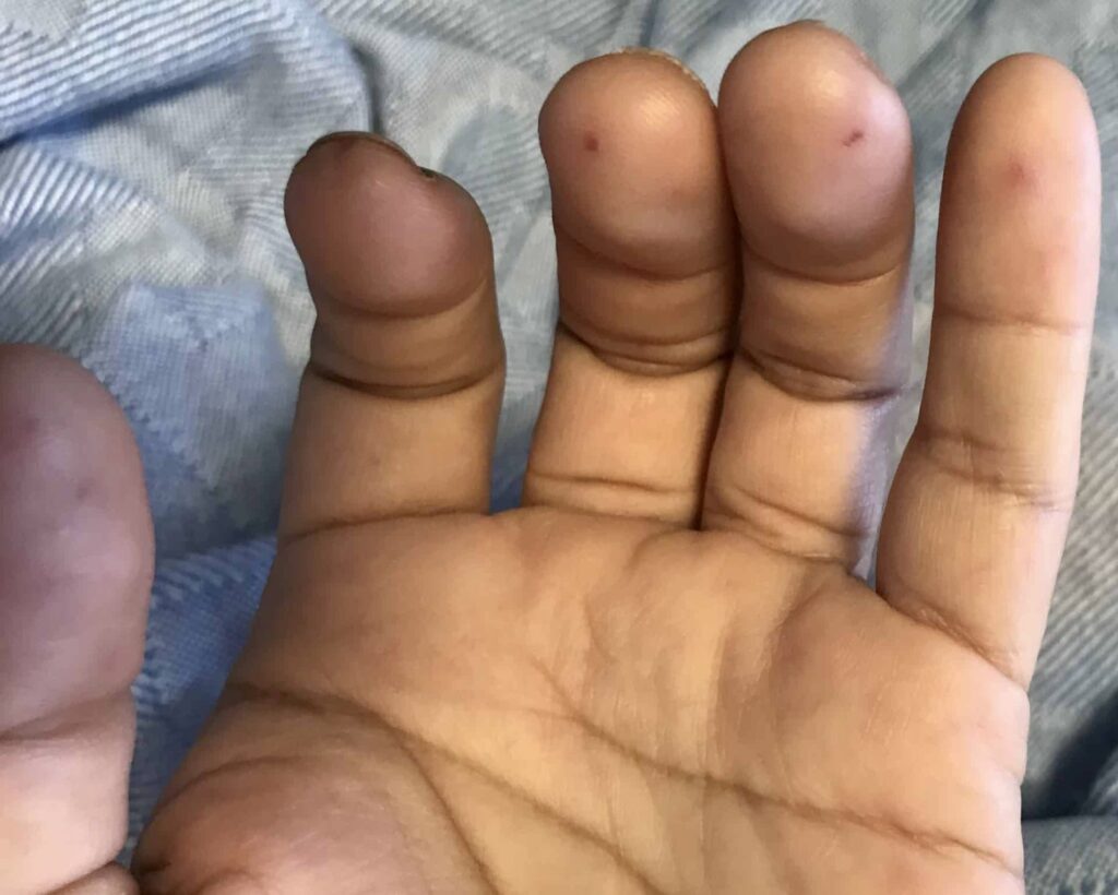 Janeway lesions finger tips