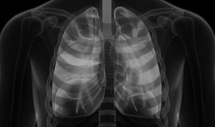 Pulmonary Puzzler-LITFL 700