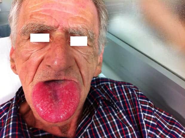 angioedema tongue