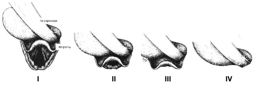 Cormack-Lehane scoring system laryncoscopy