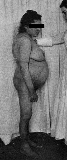 Cushing’s Syndrome I (1912)