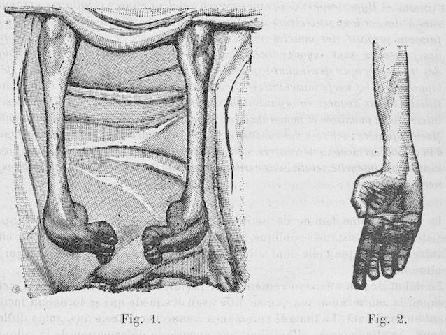 Dejerine-Sottas disease 1893 67-68