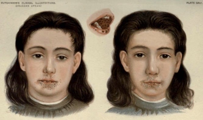 Hutchinson Pigmentation of lip and mouth 1896 Plate CXLI