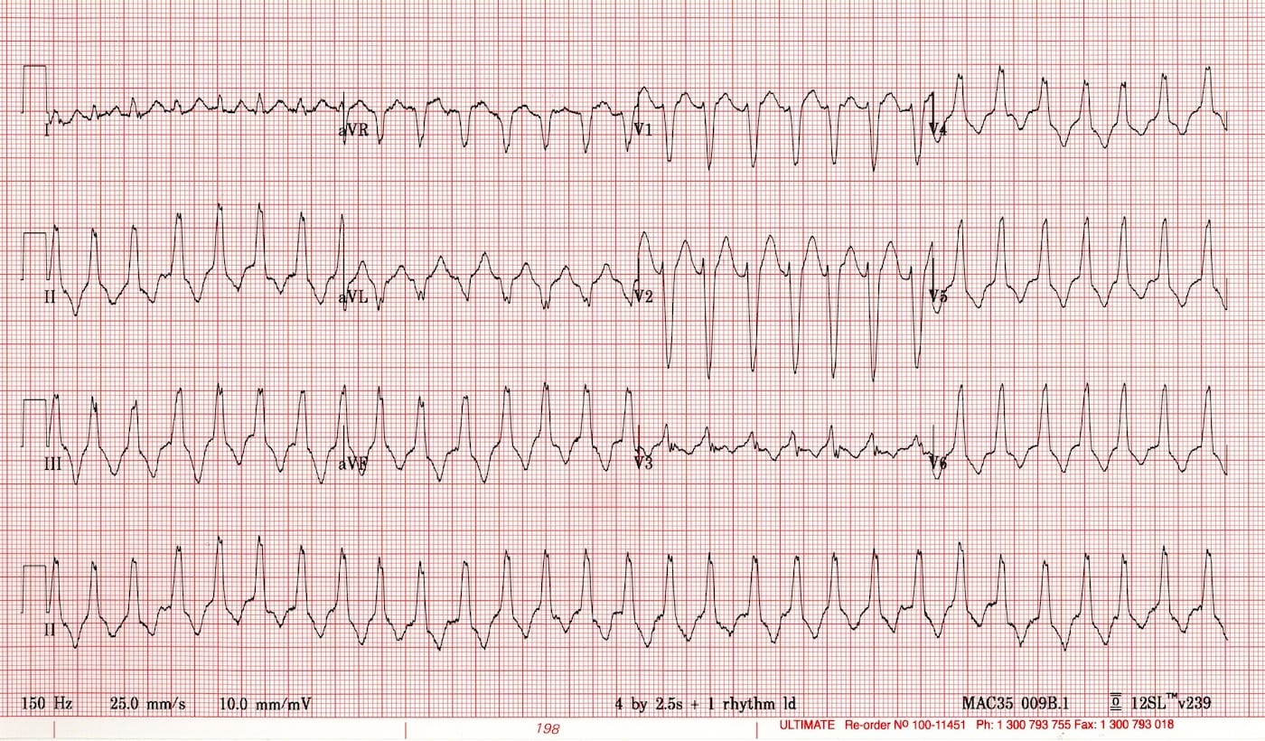 wide qrs complex tachycardia