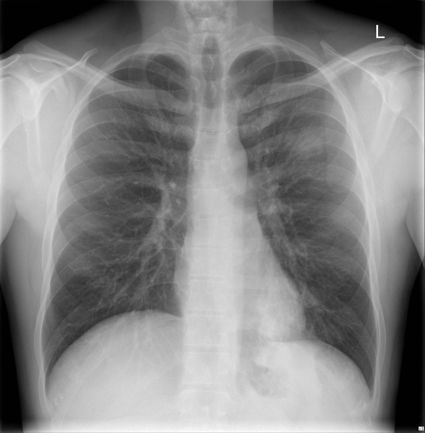 pneumonia cxr findings