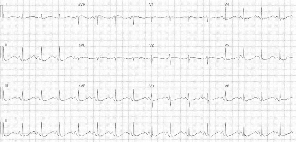 ECG Case 101 LITFL Top 100 EKG