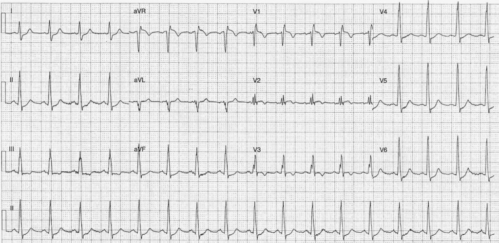 ECG Case 104 LITFL Top 100 EKG