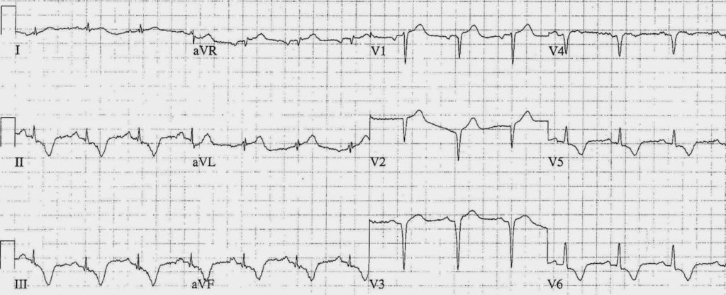 ECG Case 106 LITFL Top 100 EKG