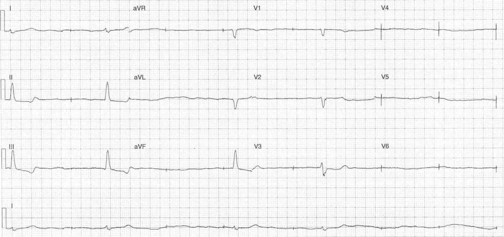 ECG Case 107 LITFL Top 100 EKG