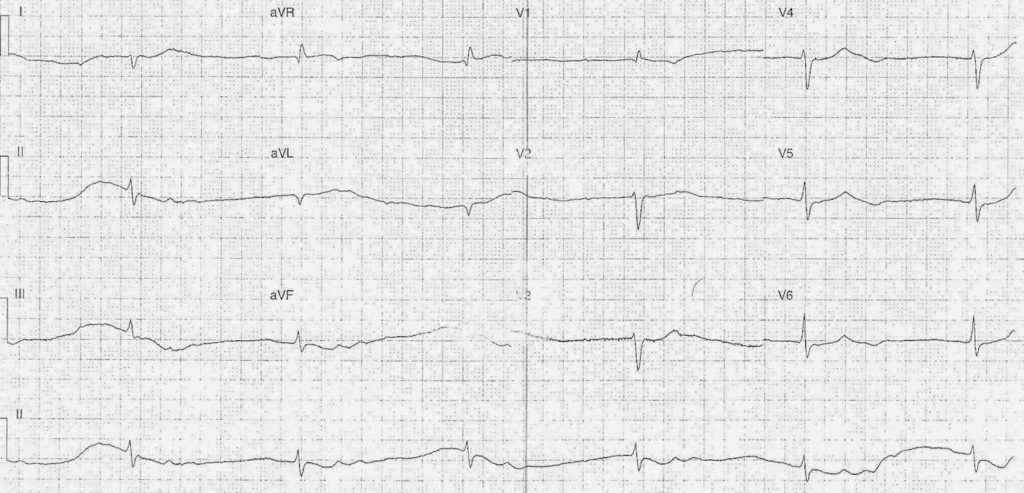 ECG Case 109a LITFL Top 100 EKG