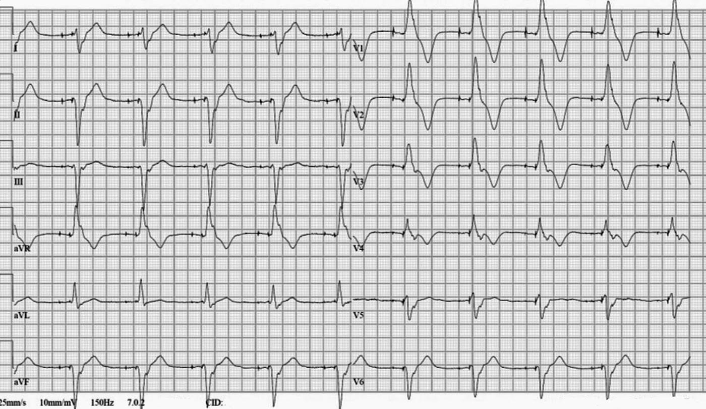 TD ECG L1S1, PDF, Électrocardiographie