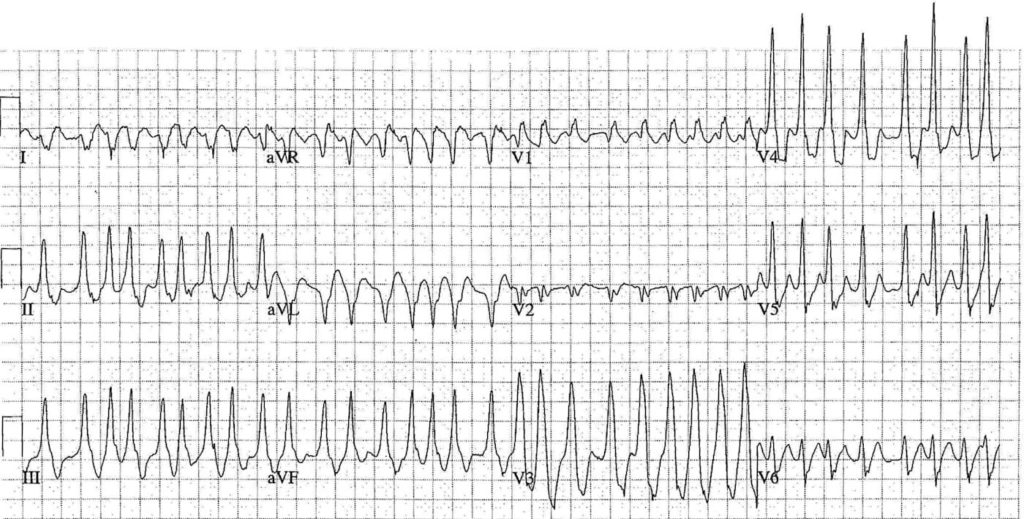 ECG Case 112 LITFL Top 100 EKG