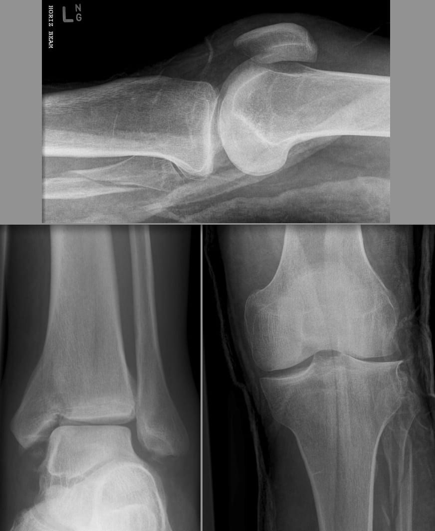 maisonneuve fracture