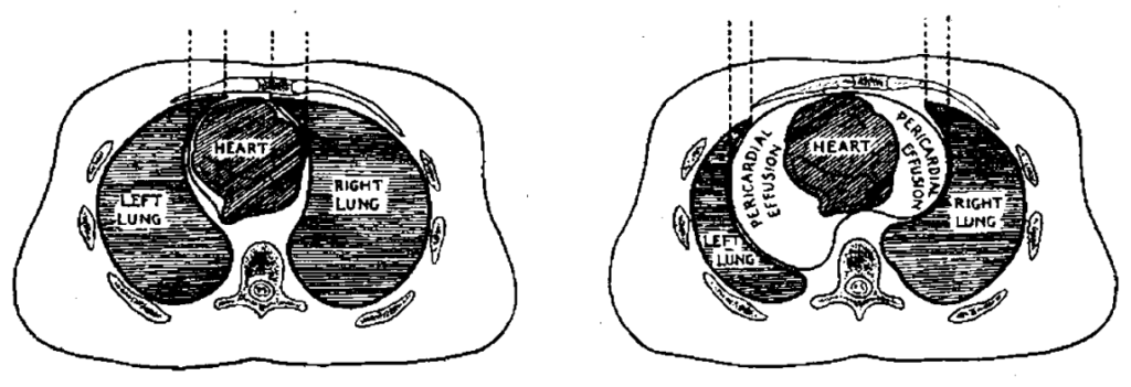 Moschcowitz triad 1933