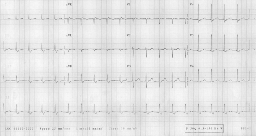 AVNRT ECG Library 03