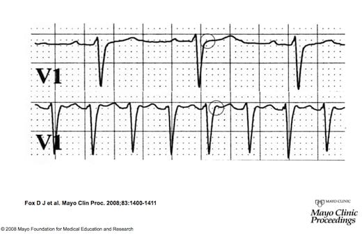 av nodal reentrant tachycardia