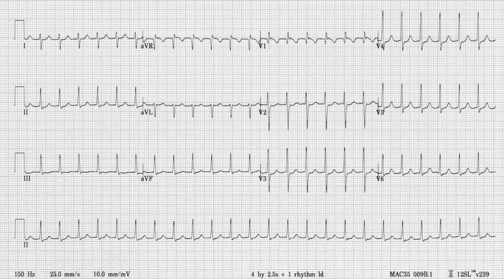 AVNRT slow fast ECG Library 001