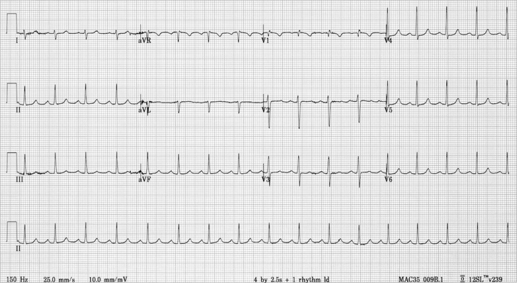 AVNRT slow fast ECG Library 02