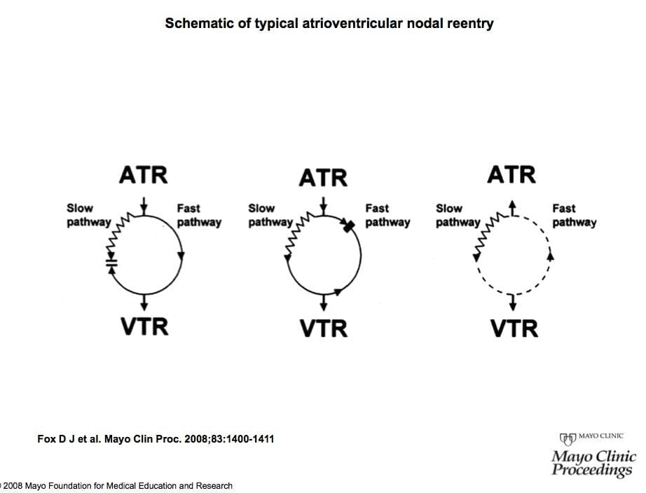 av nodal reentrant tachycardia