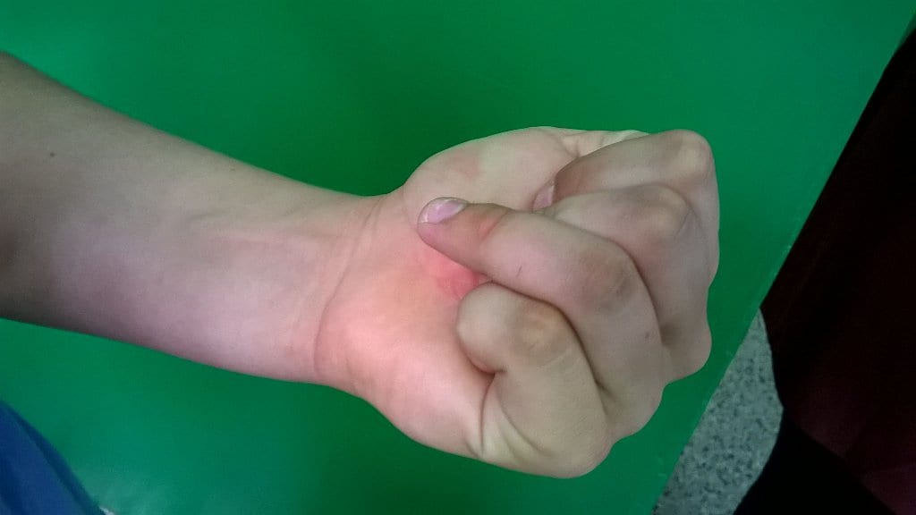 Jersey Finger • LITFL • Trauma Library