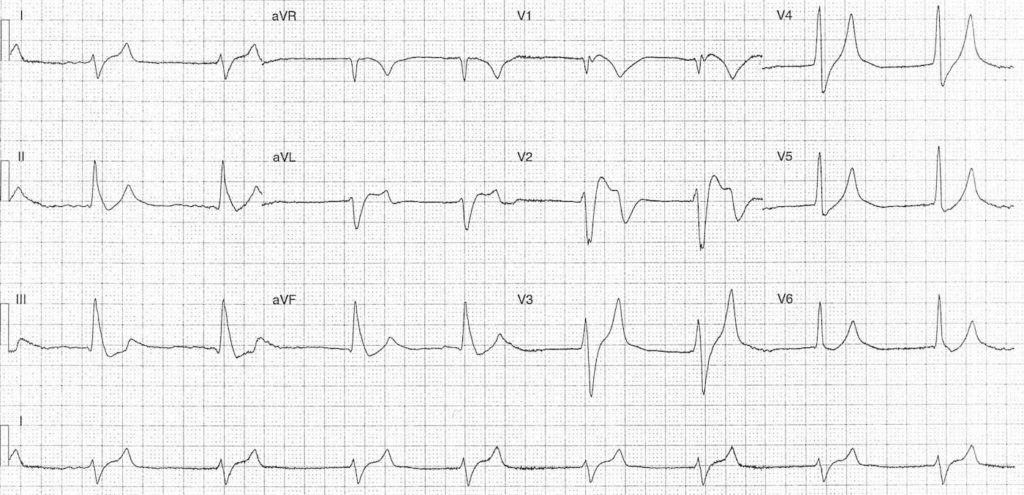 ECG Case 118a LITFL Top 100 EKG