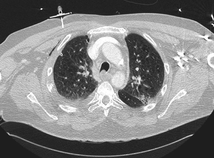 Tension Pneumothorax Time To Change The Old Mantra Litfl