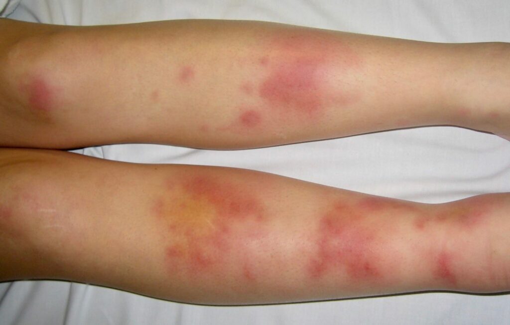 ICE 003: Leg skin rash • LITFL • ICE Clinical Cases