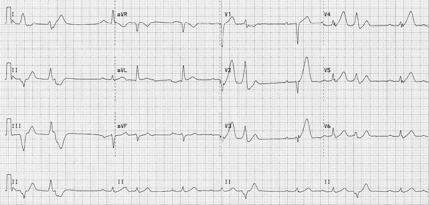 myocardial infarction ecg strip