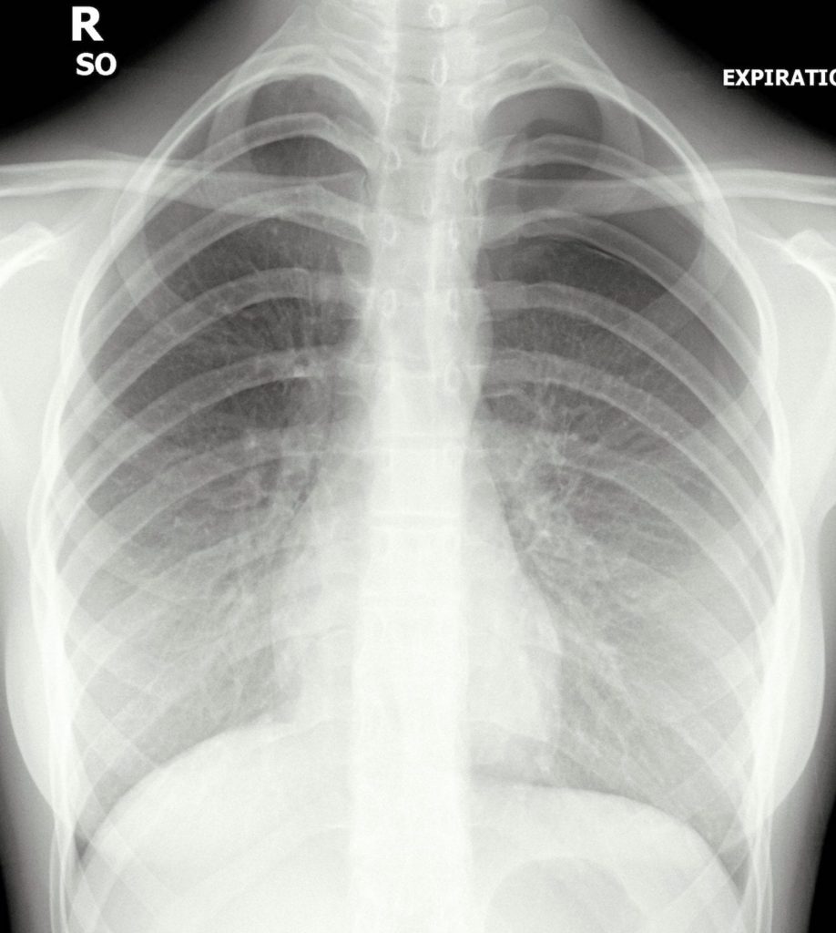 ICE 014 Pleuritic Pain • LITFL • ICE Clinical Cases