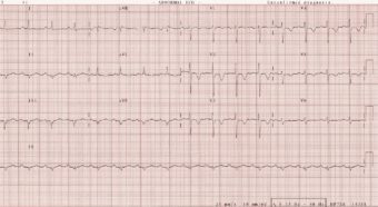 ICE 016 Delayed presentation chest pain • LITFL • ICE Clinical Cases