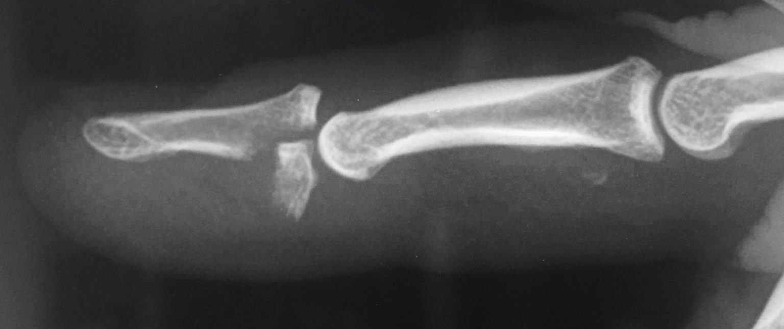 Jersey Finger • LITFL • Trauma Library