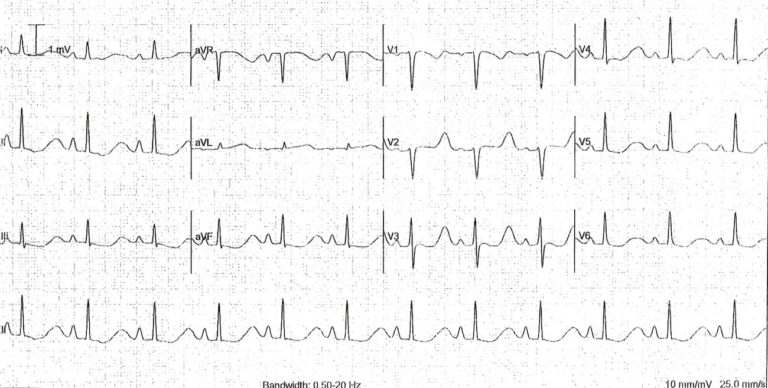 ecg-rule-of-fours-litfl-ecg-library