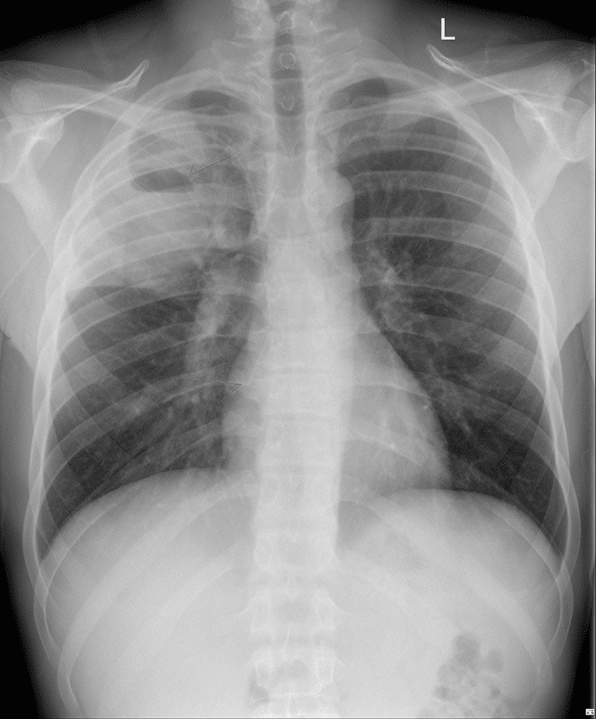 CXR-RUL-abscess