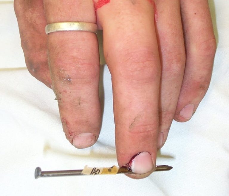 Nail Gun Injuries • LITFL • Trauma Library