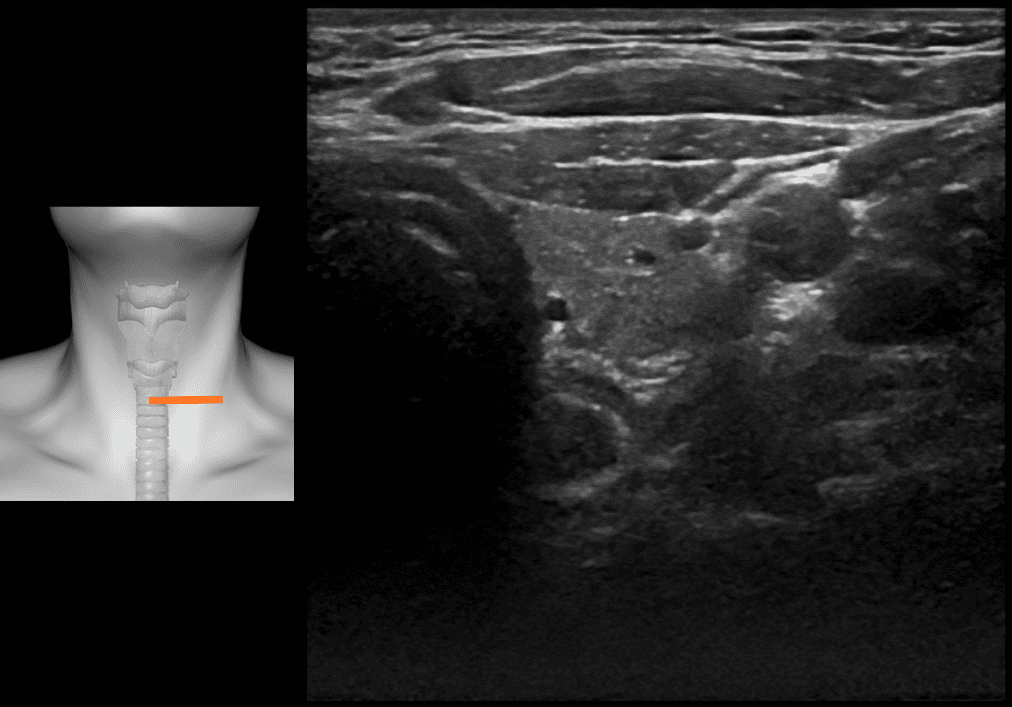 Airway ultrasound the oesophagus • LITFL • Ultrasound Library