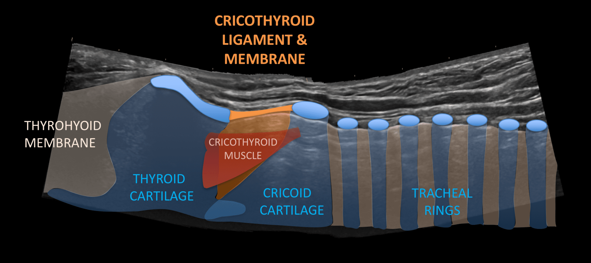 Airway Ultrasound Longitudinal Views • Litfl • Ultrasound Library