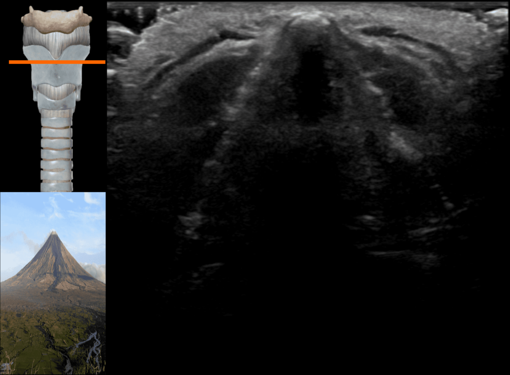 thyroid cartilage x ray