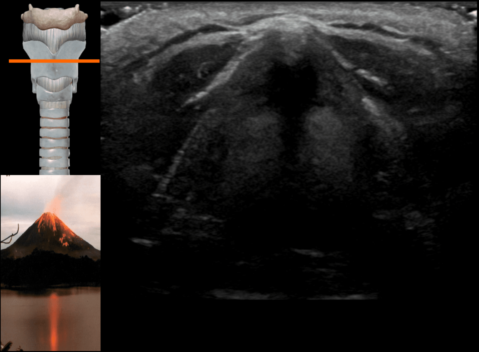 Airway ultrasound transverse views • LITFL • Ultrasound Library