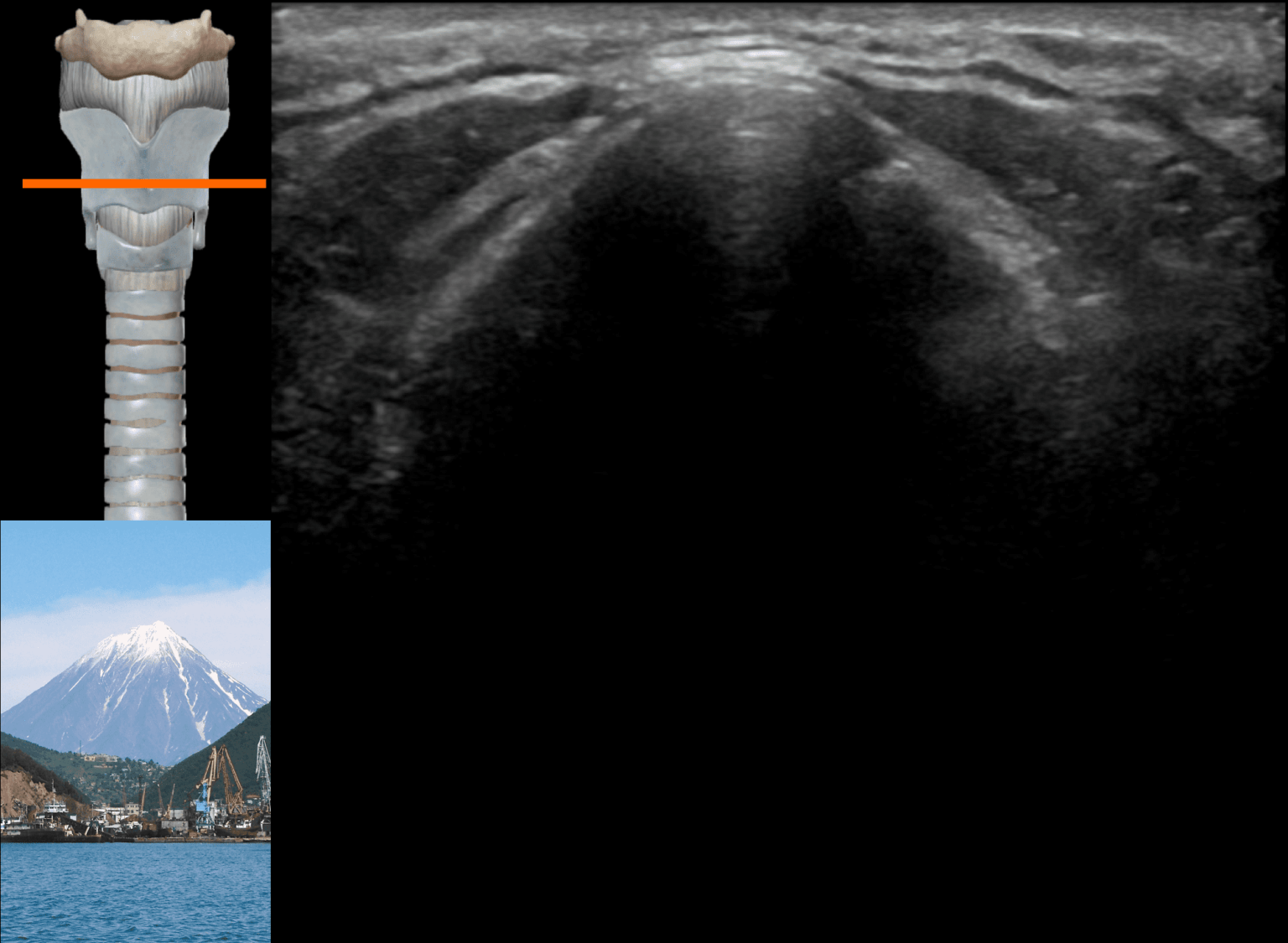 Airway ultrasound transverse views • LITFL • Ultrasound Library