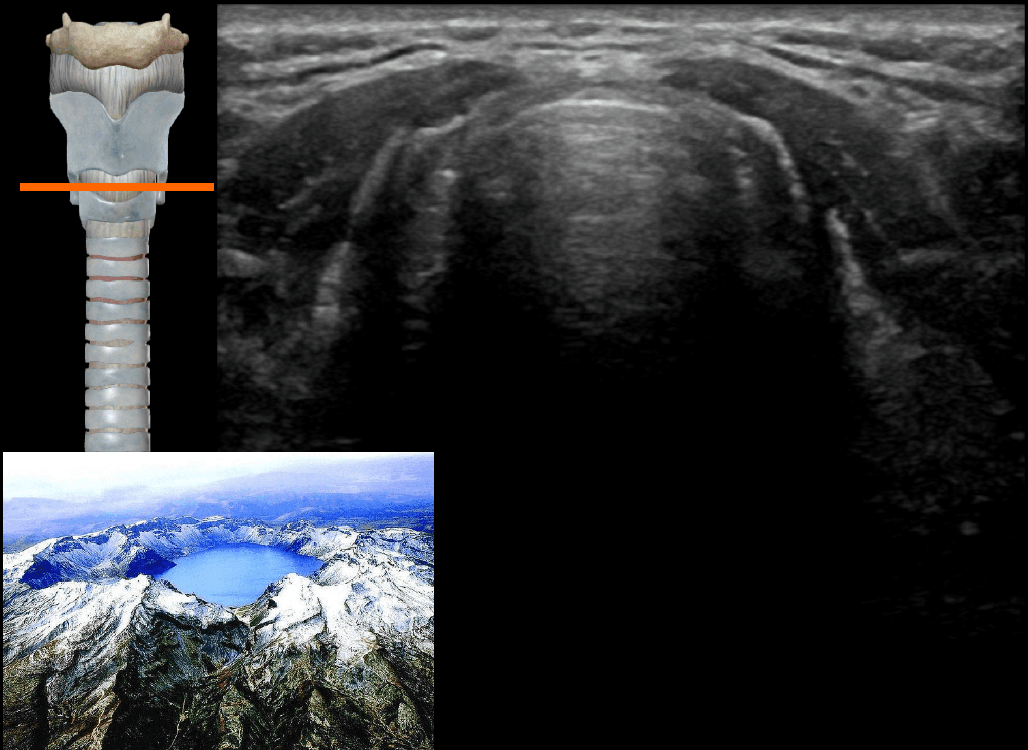 Airway Ultrasound Transverse Views • Litfl • Ultrasound Library