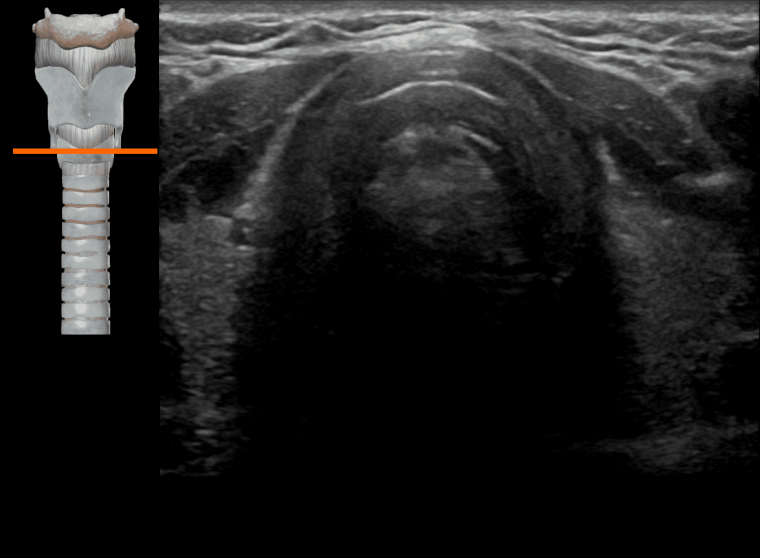 Airway ultrasound transverse views • LITFL • Ultrasound Library
