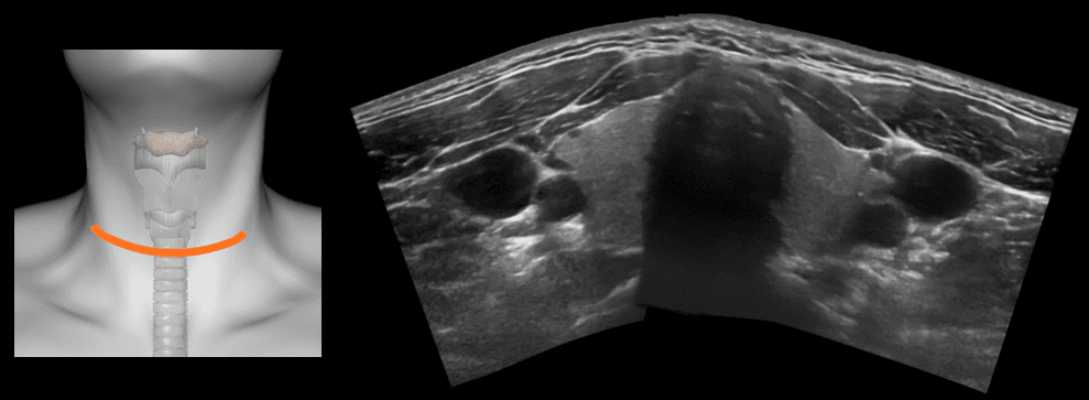 Airway Ultrasound The Oesophagus • Litfl • Ultrasound Library