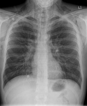 Pneumomediastinum in asthmatic